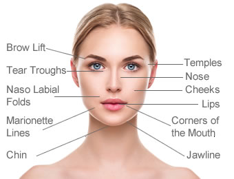 Dermal Fillers face map