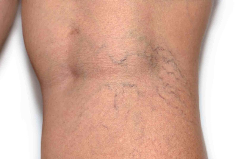 Spider leg veins